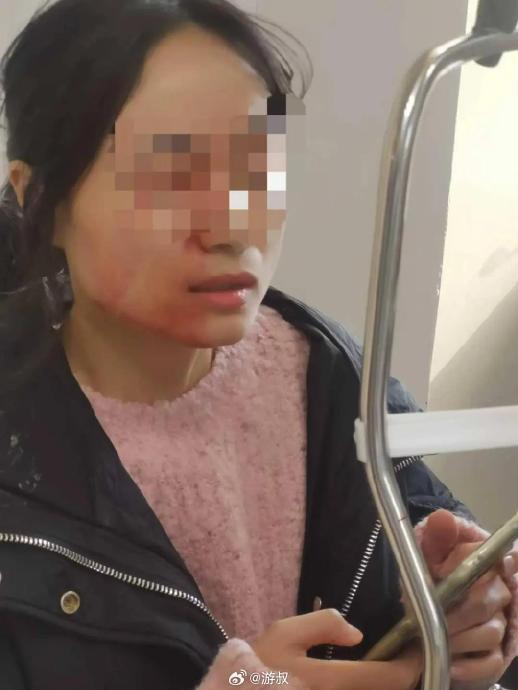 女教師因勸架被女小學生用鉗仔插傷右眼。南方都市報 女教師因勸架被女小學生用鉗仔插傷右眼。南方都市報