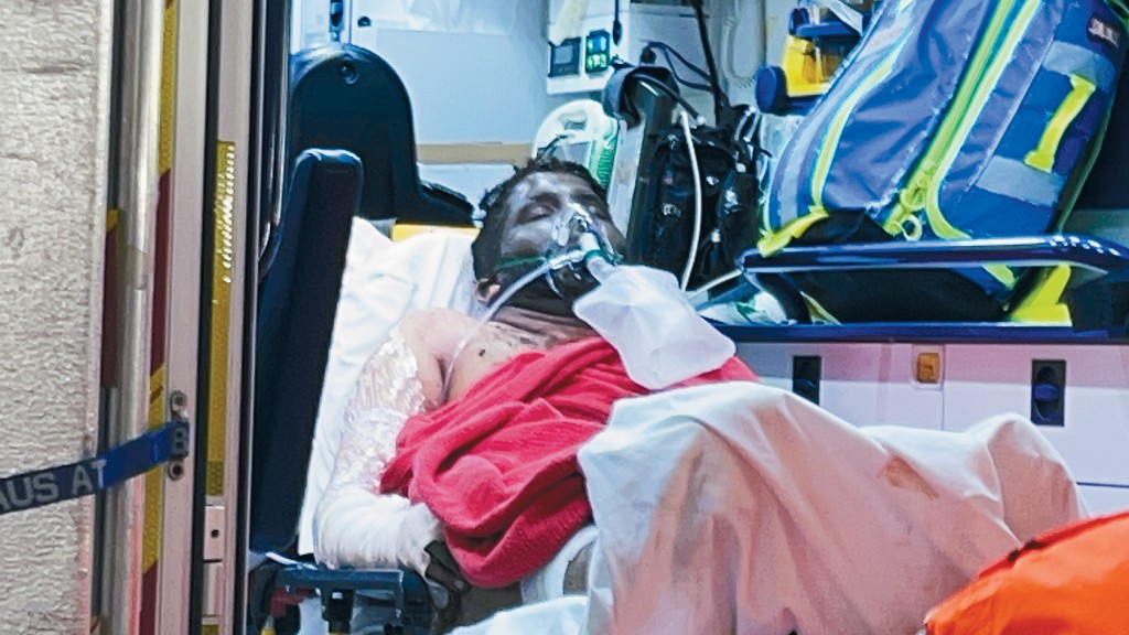 其中一名身体多处烧伤伤者送院救治。