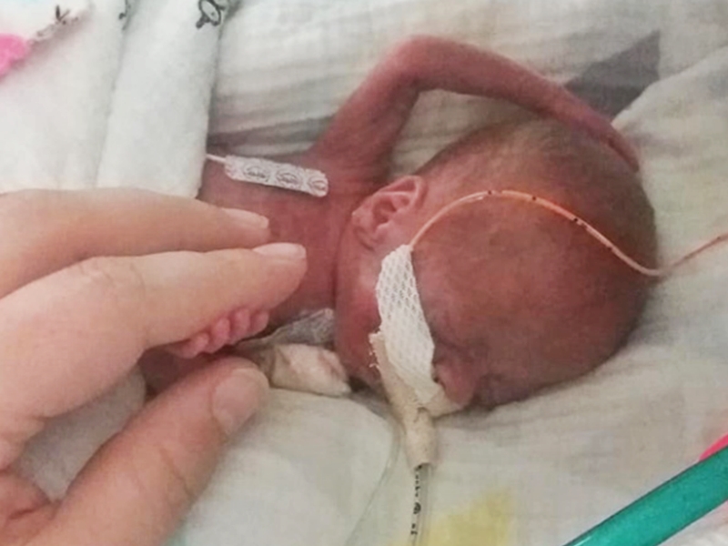 Richard早產131天，起初僅有父母一隻手掌的大小。網圖