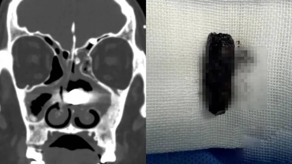 男子鼻流膿傳異味多月不癒，驚揭螺絲「藏」鼻腔40年。