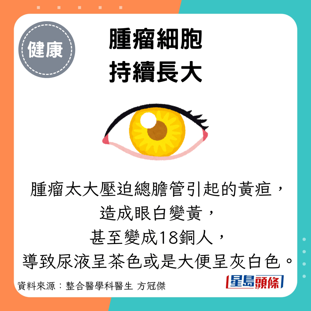 腫瘤細胞 持續長大：腫瘤太大壓迫總膽管引起的黃疸， 造成眼白變黃， 甚至變成18銅人， 導致尿液呈茶色或是大便呈灰白色。