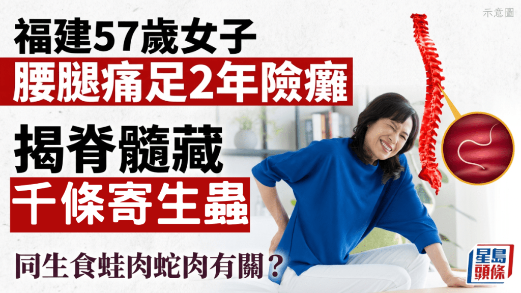 57歲婦腰腿痛足2年 千條寄生蟲入侵脊髓險癱 感染「歐猬疊宮絛蟲」與生食蛙/蛇有關？