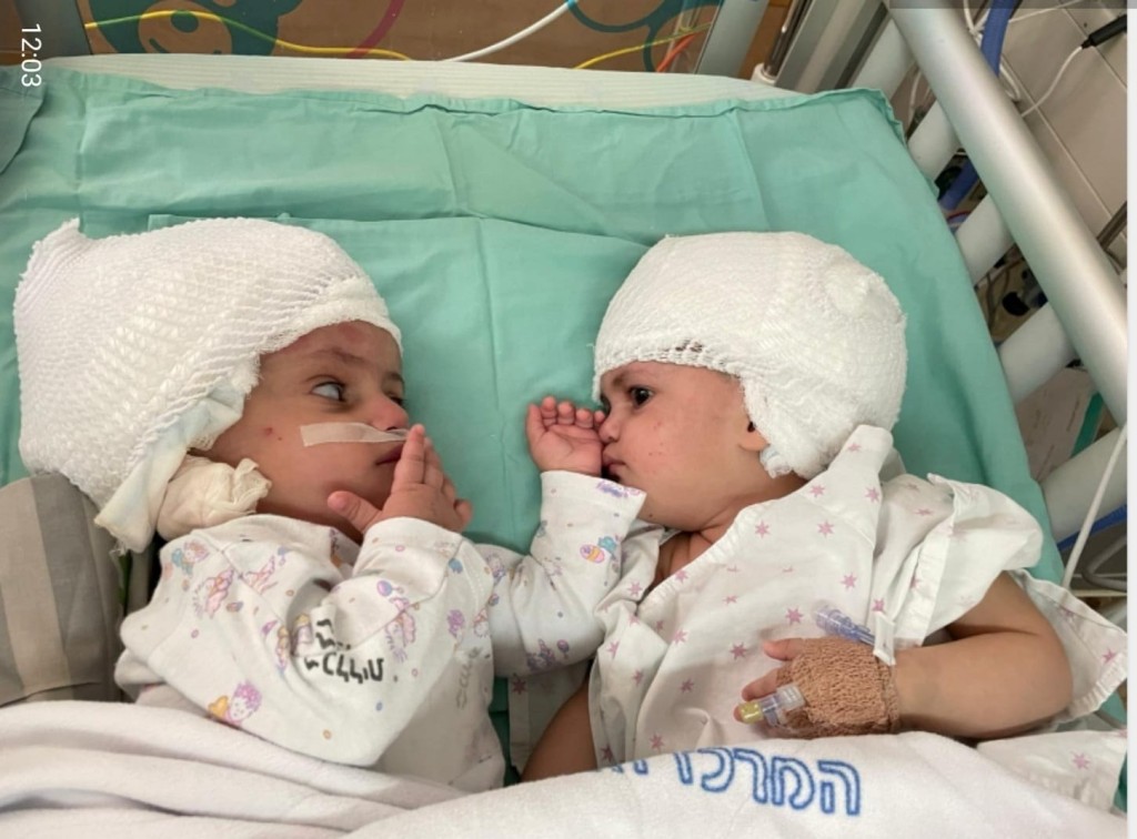 以色列一對連體女嬰接受分離手術後互望對方。路透社
