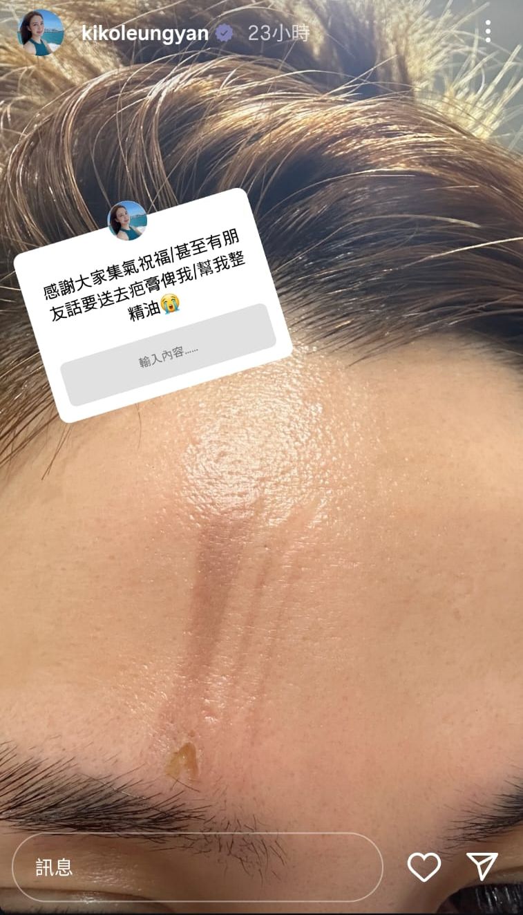 梁茵昨日在IG限時動態透露遭電髮棒傷額頭。 梁茵昨日在IG限時動態透露遭電髮棒傷額頭。