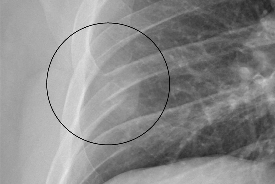 X光檢查後發現男子右側第七肋骨斷裂。男子劇烈咳嗽，後來出現胸痛症狀。（圖片來源： 胸腔科醫生蘇一峰Facebook專頁）