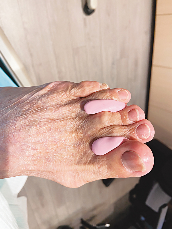 ●矯正腳趾畸形常用的矽膠趾托。