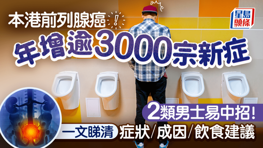 本港前列腺癌年增逾3000宗新症 2類男士易中招！一文睇清症狀/成因/飲食建議