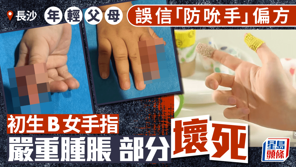 綁繃帶防吮手？︱年輕父母誤信網上謬論   初生B手指腫脹部分壞死