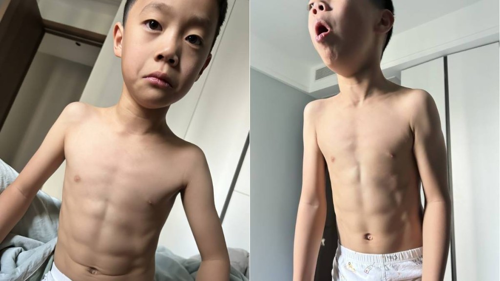 西安有7歲男童感冒咳嗽10日後,腹部出現明顯腹肌,令網民覺得很神奇。