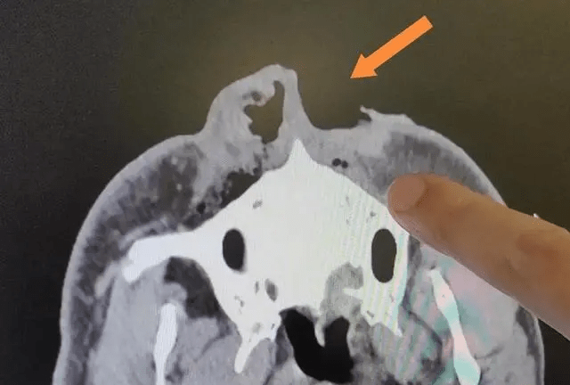 X光检查显示，何运光鼻子被黑熊咬掉一半。