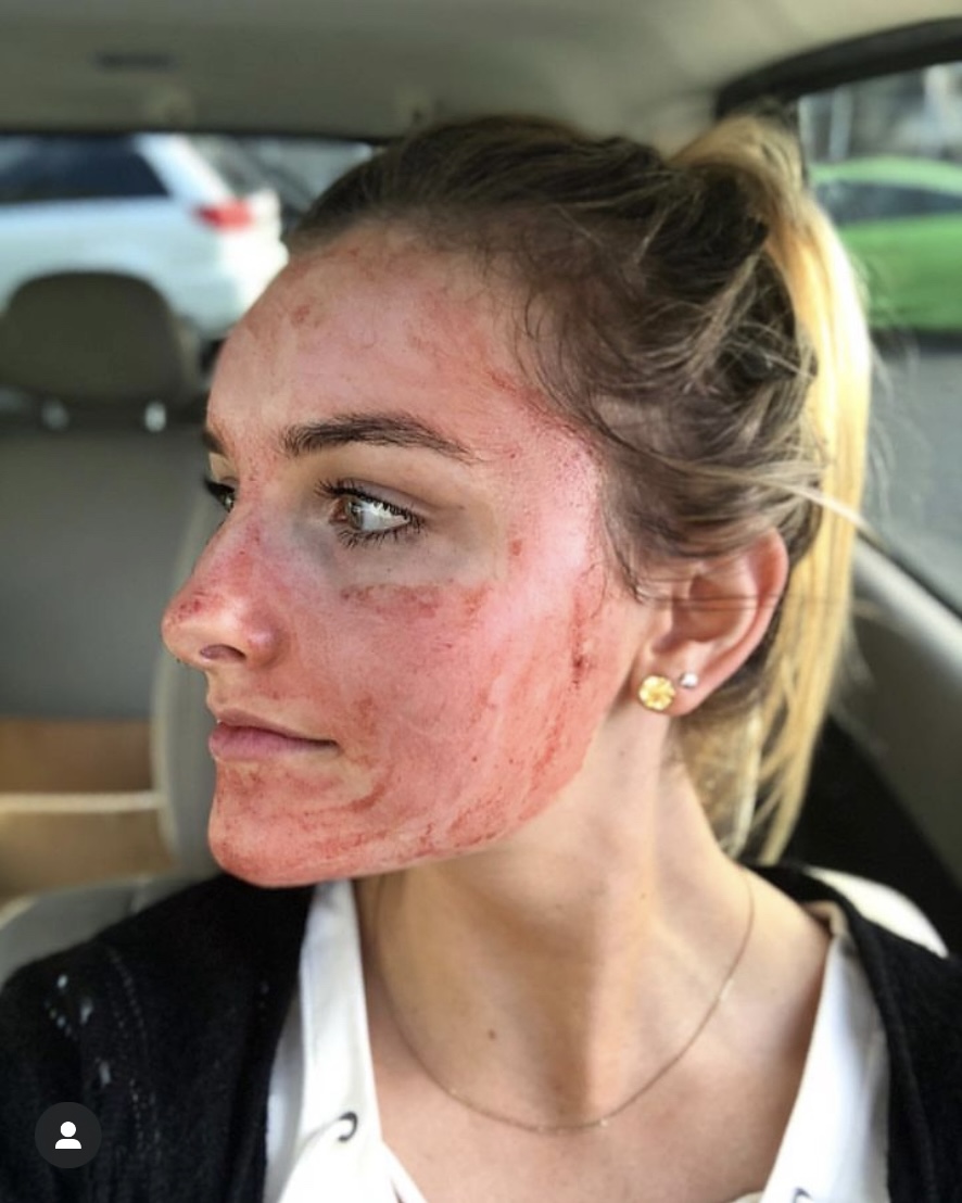 据网民分享，「吸血鬼美容」约3天后皮肤像晒伤脱皮，约一周就能复原。 Instagram