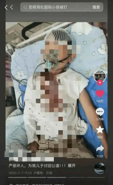 昆明8歲童遭醉漢誤傷,顱骨粉碎性骨折。 昆明8歲童遭醉漢誤傷,顱骨粉碎性骨折。