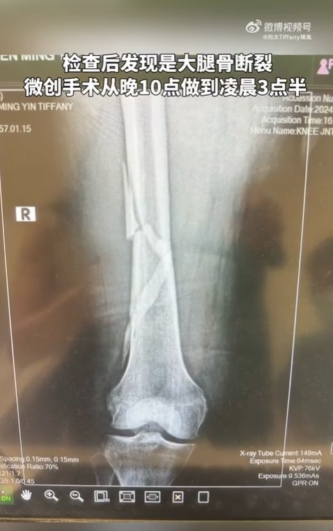 向太入院檢查後發現大腿骨斷裂。
