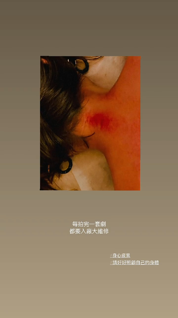 肩頸刮痧後嚴重發紅。