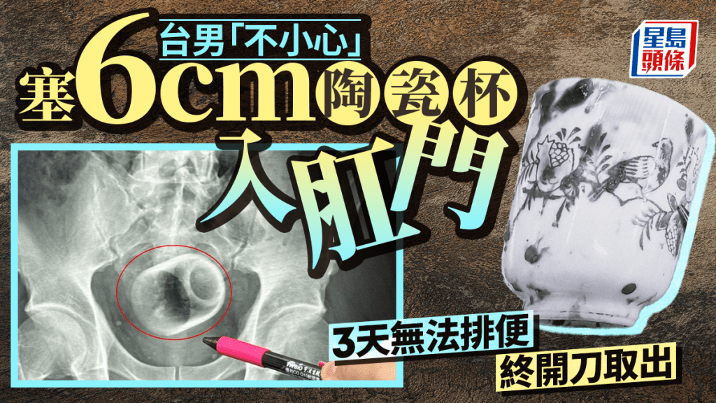 台男肛門塞6cm陶瓷杯  3天無法排便終開刀取出