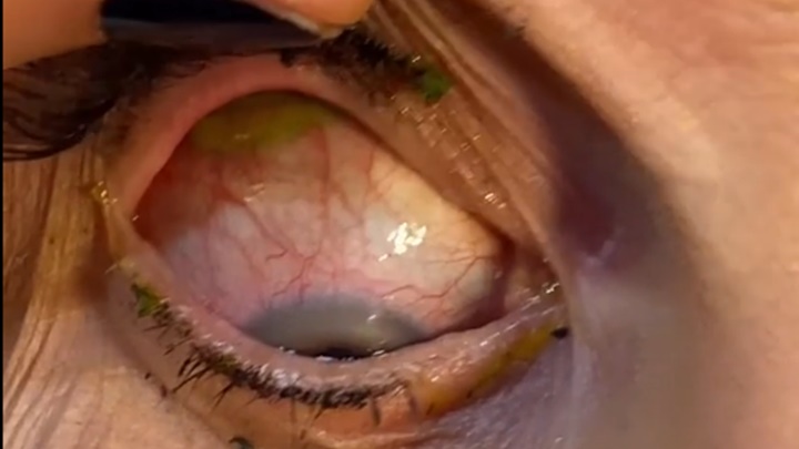 醫生翻開病人的上眼瞼，發現藏有一片隱形眼鏡。網上影片截圖