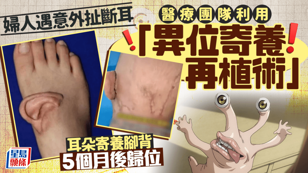 婦意外被扯斷耳 寄養腳背5個月後歸位