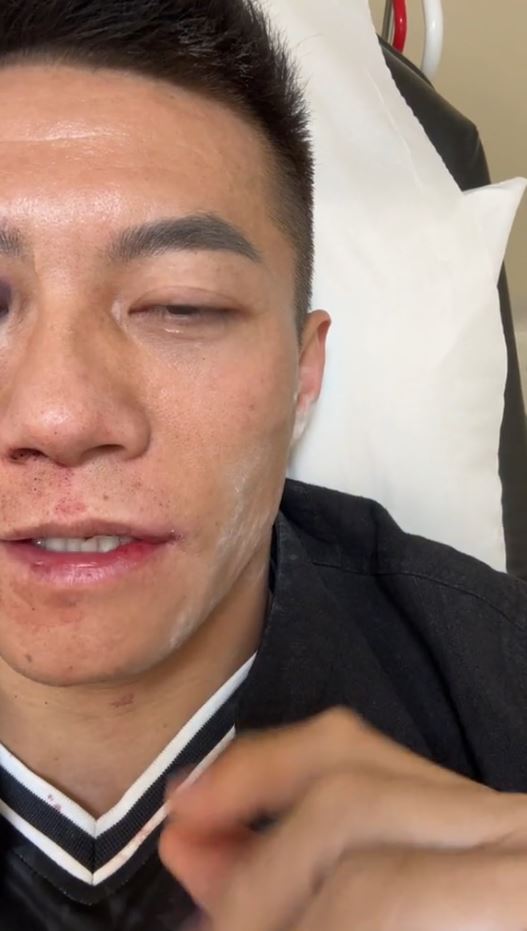 打耳光大賽後，趙鴻剛拍片報平安，但刻意不讓另一邊眼入鏡。