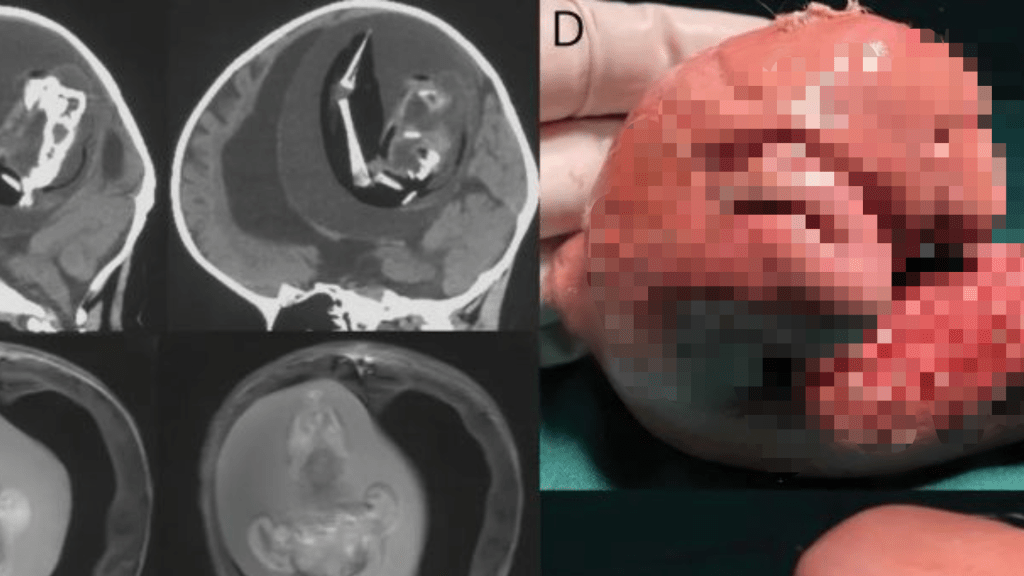 女嬰行動遲緩，一檢查發現大腦裡有她的雙胞胎姊妹。 《神經學》期刊圖片
