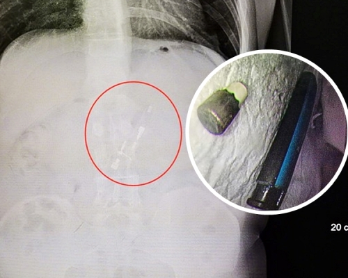 打火機被吞到胃部,取出後竟仍能點火。網圖