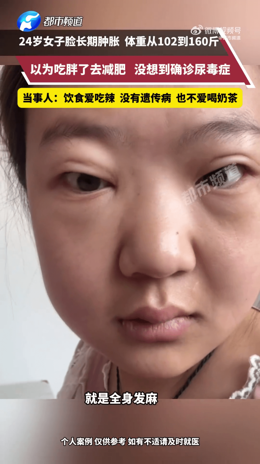 暴增近30kg以為吃多了，女子半年減肥25kg後確診尿毒症。 都市頻道