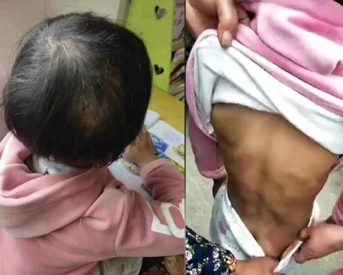 9歲女童遭祖母家暴,全身多處瘀青,頭髮被扯掉。(網圖)
