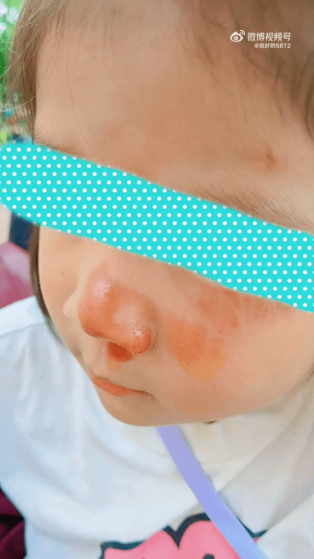 5岁女童在上海迪士尼排队时被插队黄牛撞飞脸部受伤，恐留疤痕。网图
