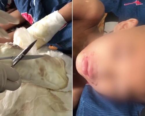 男童雙手被父親燒傷母親回應：丈夫失手造成，孩子常偷東西。(網圖)