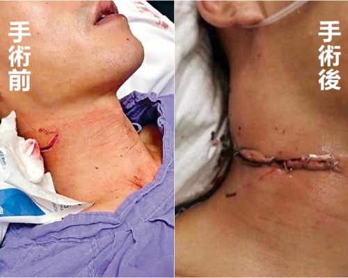 遭割頸警員傷口縫合處理引起網民爭議。網圖