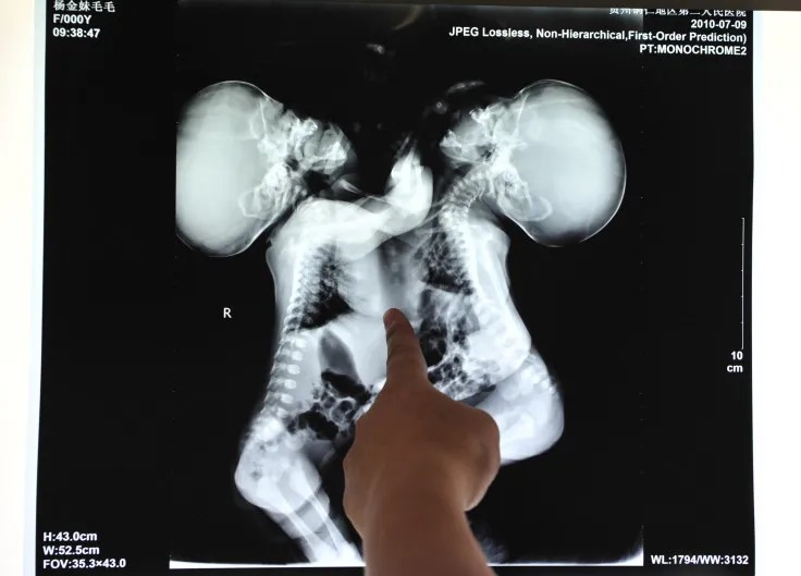 中國重慶市一家醫院的醫生為連體人檢查X 光片。路透社