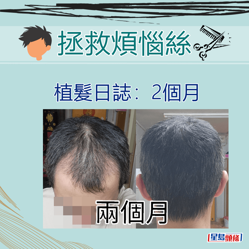 植髮日誌：2個月。「香港討論區」截圖