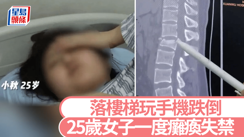 小秋事發後腰椎骨骼嚴重受損。紅星新聞
