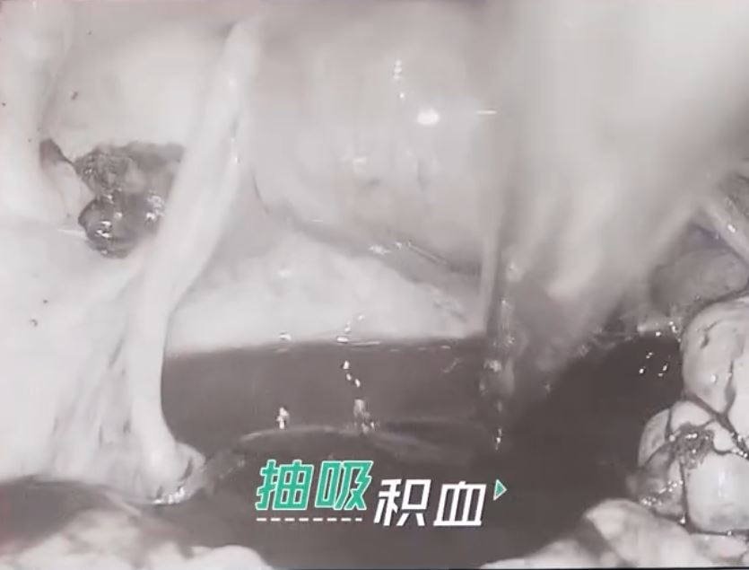 26的婷婷與男友床上「激戰」後黃體破裂大血崩險死。第一現場