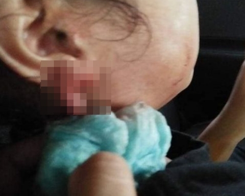 大馬女童耳垂被扯下一塊肉。網上圖片