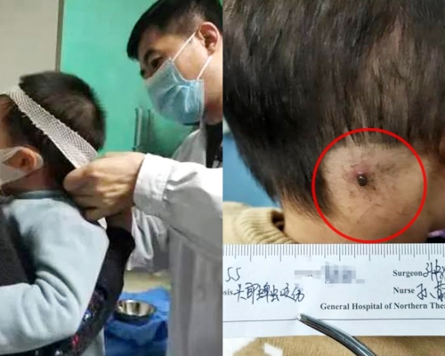 遼寧2歲男童遭蜱蟲叮咬後腦。網圖