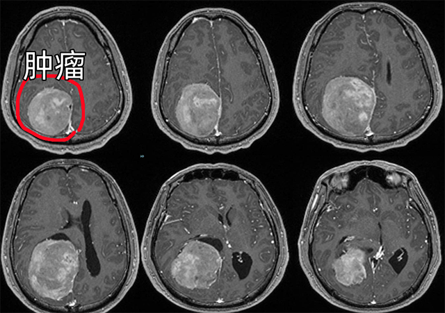 檢查影像顯示，李先生的腦瘤如同拳頭般大小，擠壓著大腦組織。（圖片來源：深圳市人民醫院）