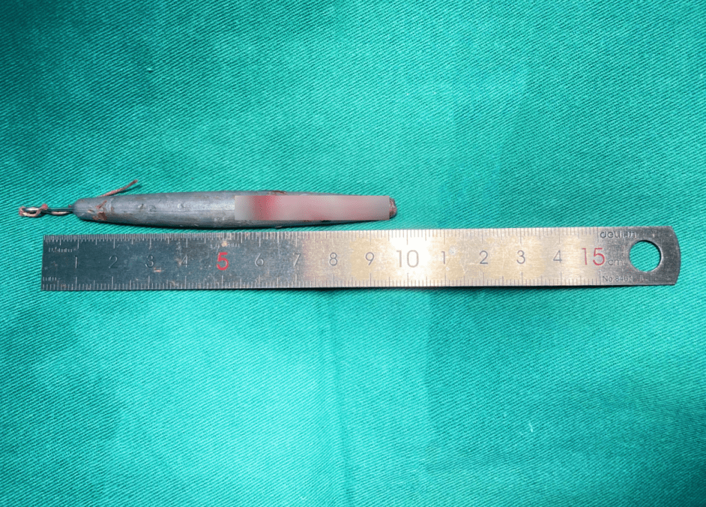 患者取出的笔形铅坠。 上海第九人民医院