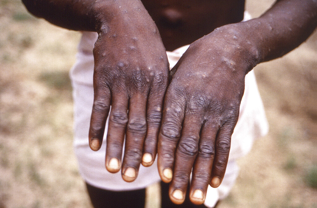 猴痘感染病徵。AP图片