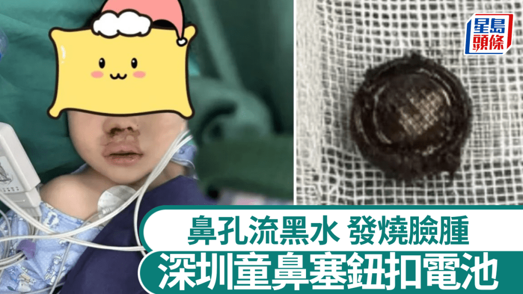 醫生從小孩鼻腔取出發黑鈕扣電池。