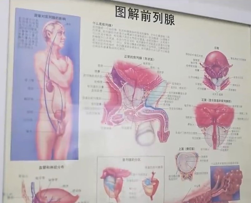 醫生從小余下體抽出177克異物。《南方都市報》