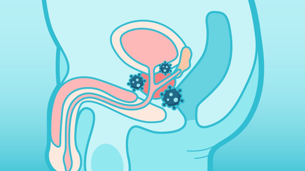 前列腺癌細胞在前列腺的外圍，因此初期不會壓著尿道，也不會出現下尿道的病徵。