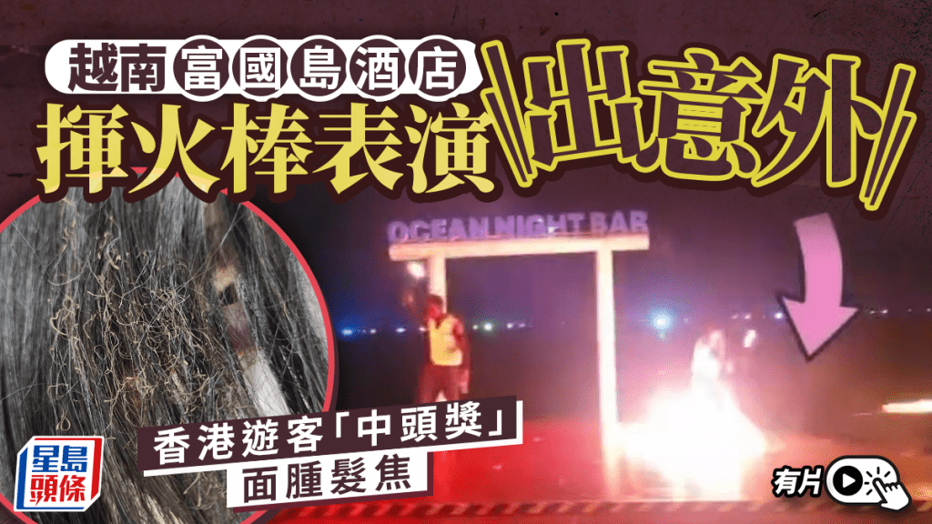 越南富國島︱酒店睇揮火棒表演出意外  港人頭部中招面腫髮焦︱有片