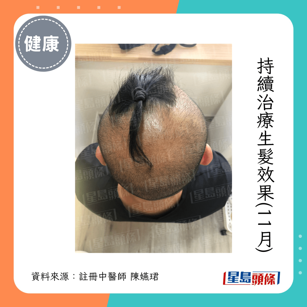 男子持续治疗，头发的再生情况（注册中医师陈嬿珺提供）