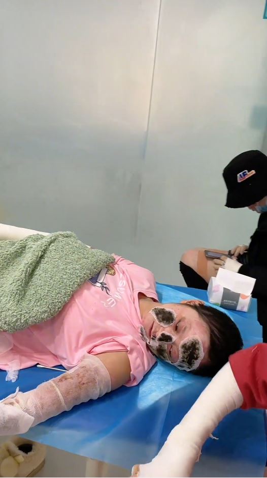 湖北女手機放枕邊通宵叉電，因充電器爆炸燒傷7成皮膚毀容。抖音＠依依的抗疤分享