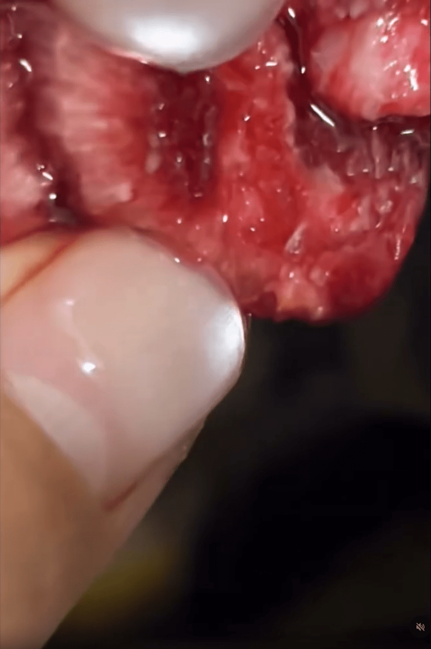 有網民在社交平台上載的影片中,可見到撕開的車厘子中竟有一條白色幼蟲正在蠕動。 有網民在社交平台上載的影片中,可見到撕開的車厘子中竟有一條白色幼蟲正在蠕動。
