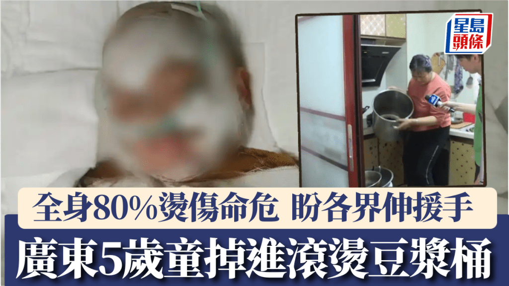 廣東5歲童掉進滾燙豆漿桶,全身80%燙傷命危,家長望各界伸援手。