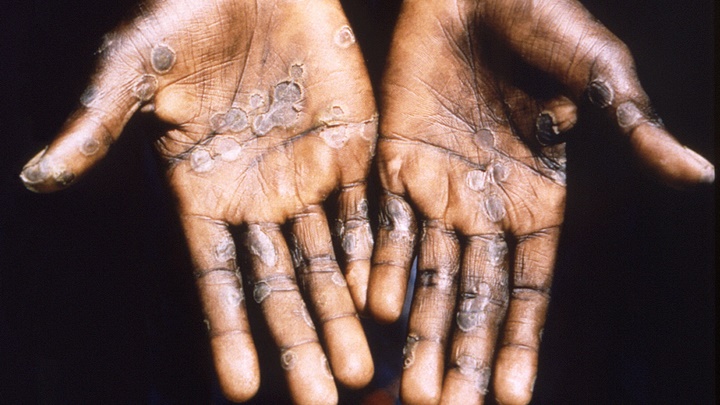 猴痘主要經體夜接觸傳播，病徵包括發燒及出疹等。路透社資料圖片