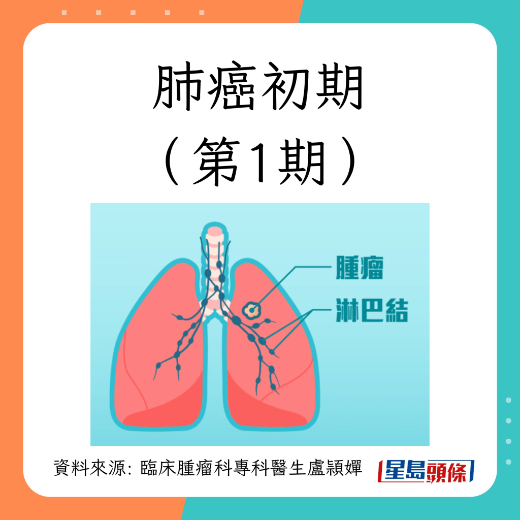 肺癌第1至4期治療方法