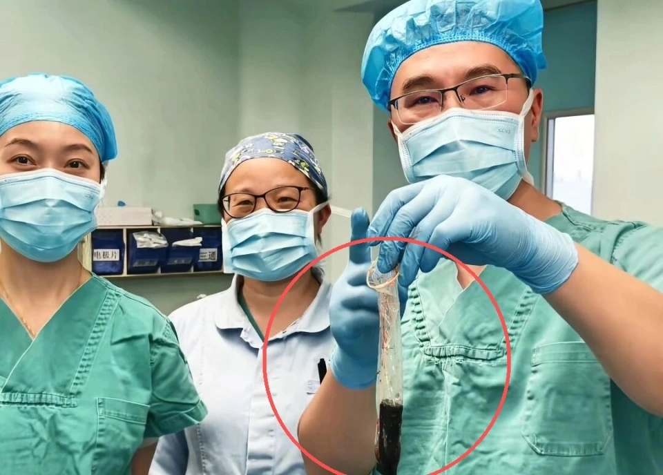 醫生團隊通過胃鏡將一個安全套送入胃腔取出打火機。 醫生團隊通過胃鏡將一個安全套送入胃腔取出打火機。