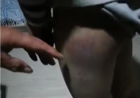 男童的臀部及腿上都有瘀傷。(網圖)